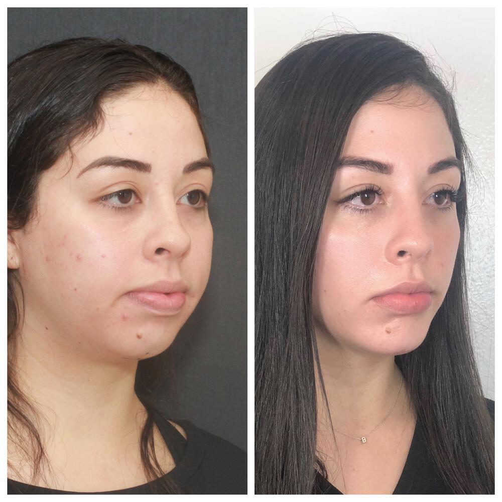 Buccal Fat Removal Before After Patient 01 Nayak Plastic Surgery