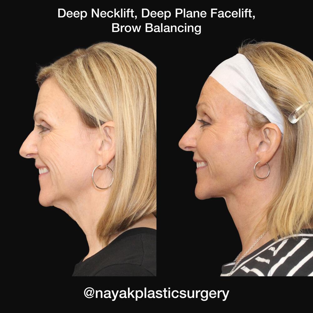 What is a Deep Neck Lift? - Dr Anzarut Plastic Surgery