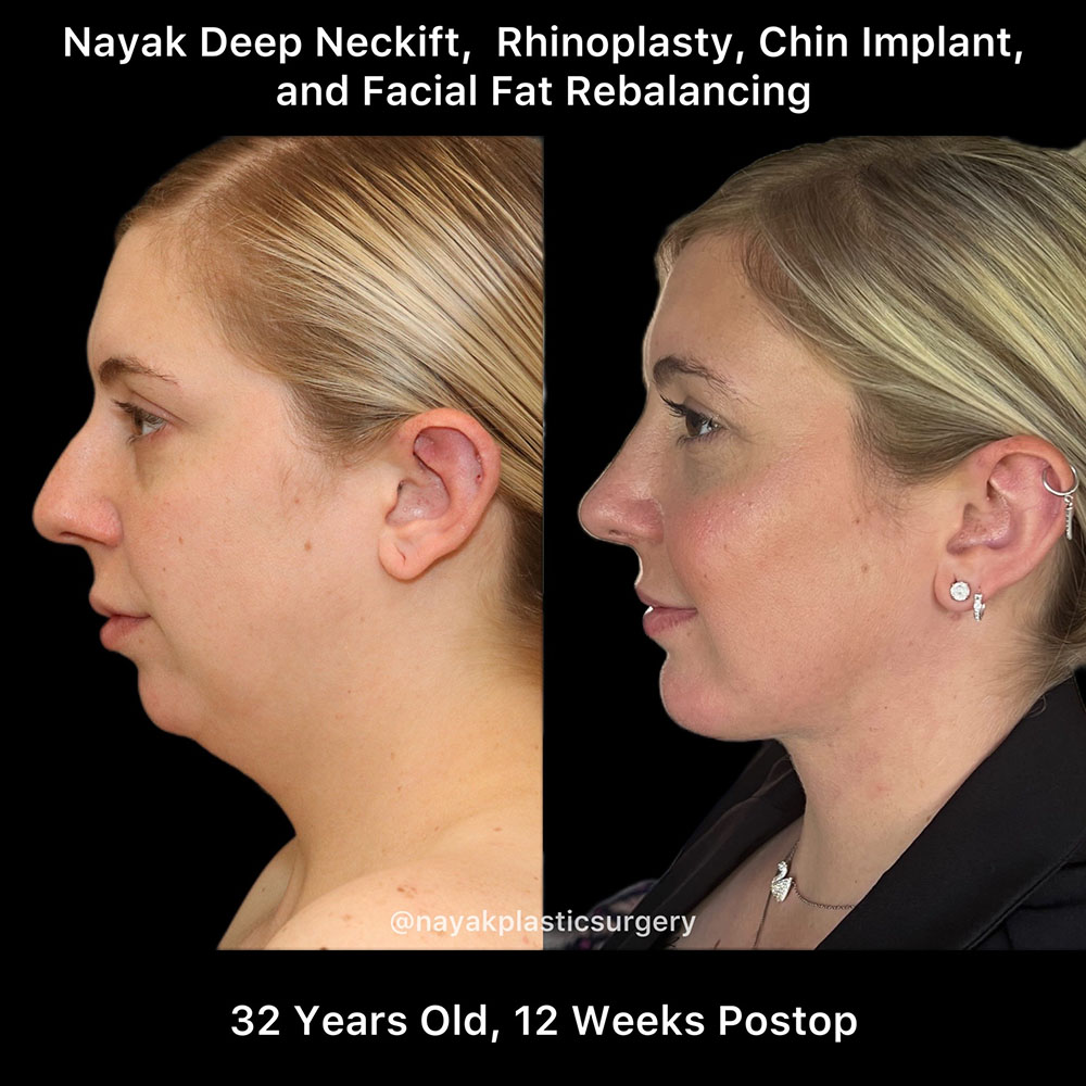 Before & After Deep Necklift Procedures in St. Louis MO