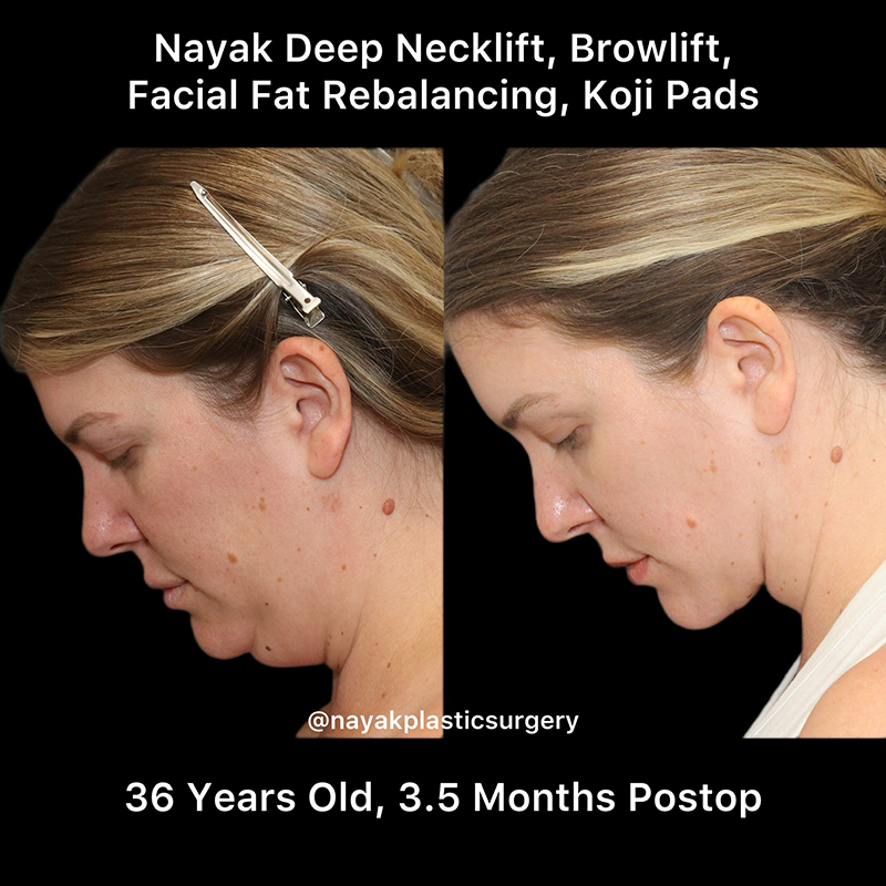 What is a Deep Neck Lift? - Dr Anzarut Plastic Surgery